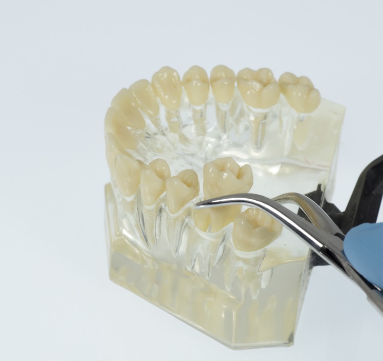 pulling a tooth reduced size image of a tooth being pulled